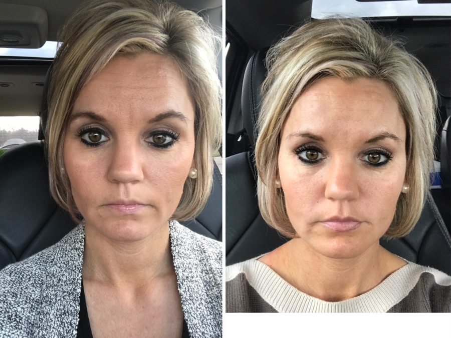 Before and After Botox and Fillers - A Cup Full of Sass