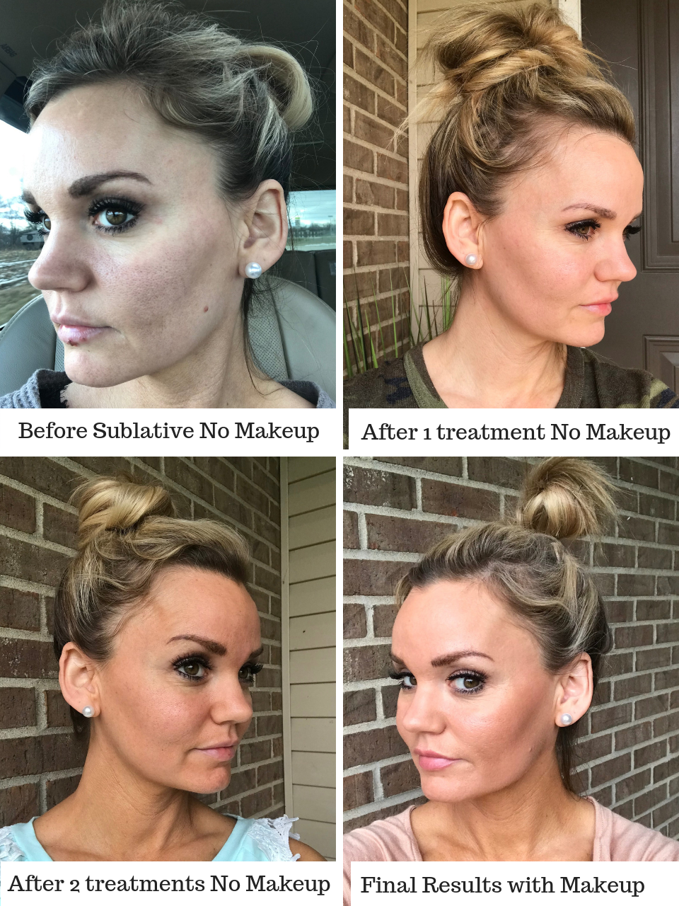Sublative Skin Rejuvenation Before and After