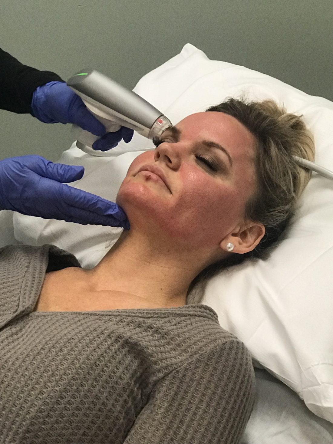 Sublative Skin Rejuvenation Before and After with Genesis Med Spa.