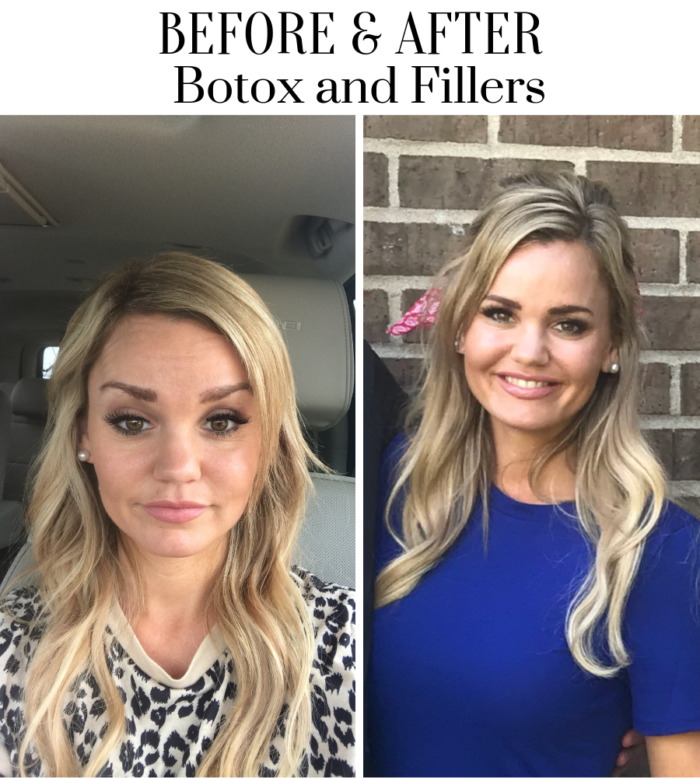 Everything you need to know about Botox and Fillers.