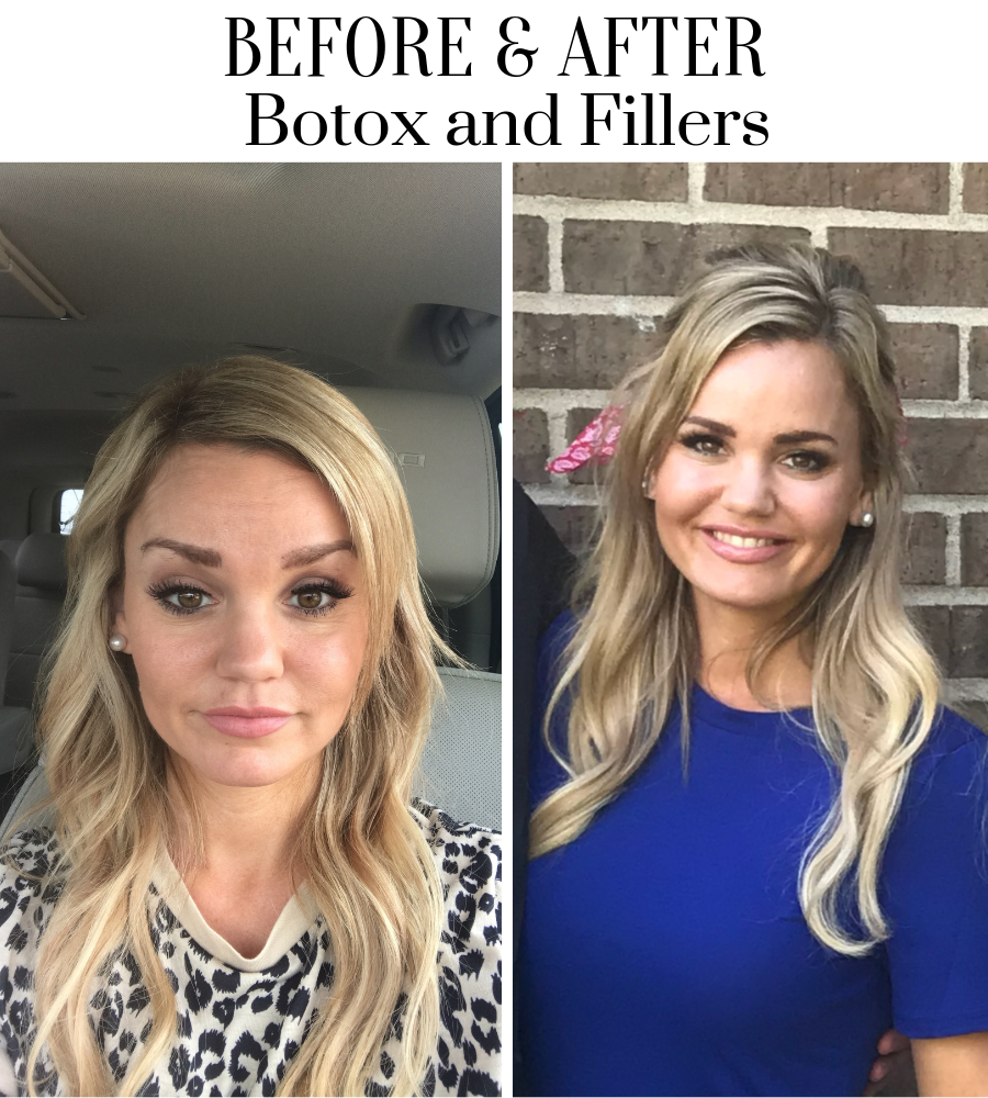 Everything you need to know about Botox and Fillers. 