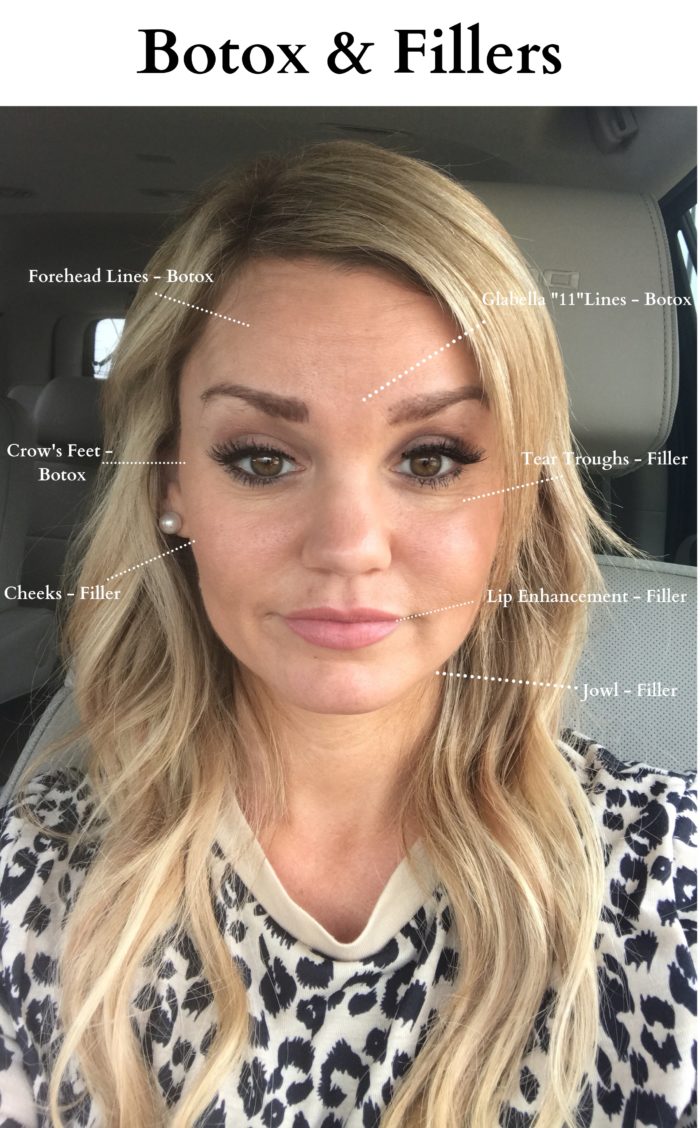 Everything you need to know about Botox and Fillers. Juvederm, Lip FIllers, Cheek Fillers.